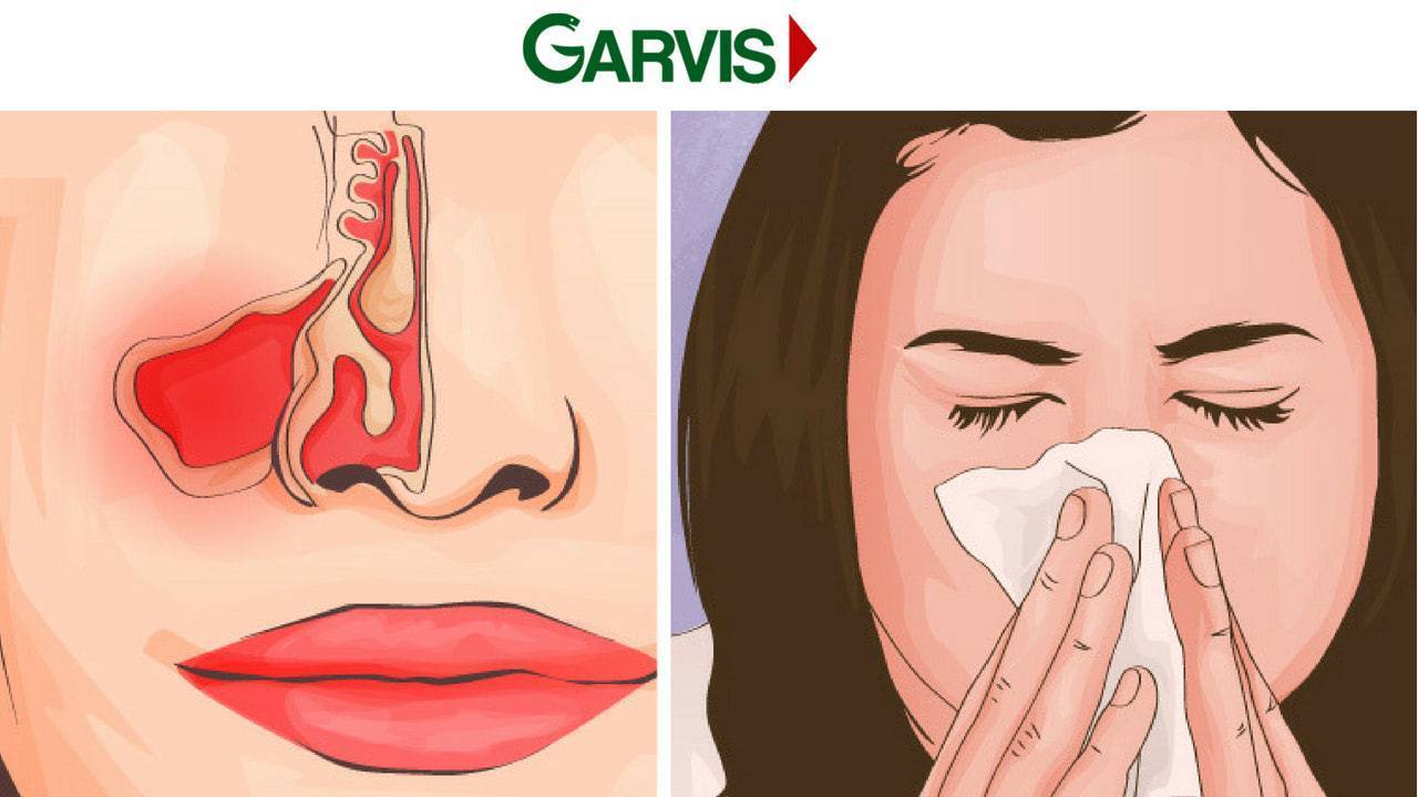 Выделения из носа, постоянное обильное выделение густой и вязкой слизи из носа, чем лечить заболевание