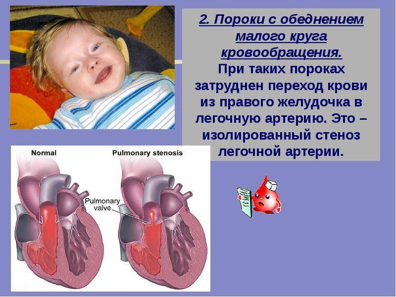 Врожденные пороки сердца (впс) у детей