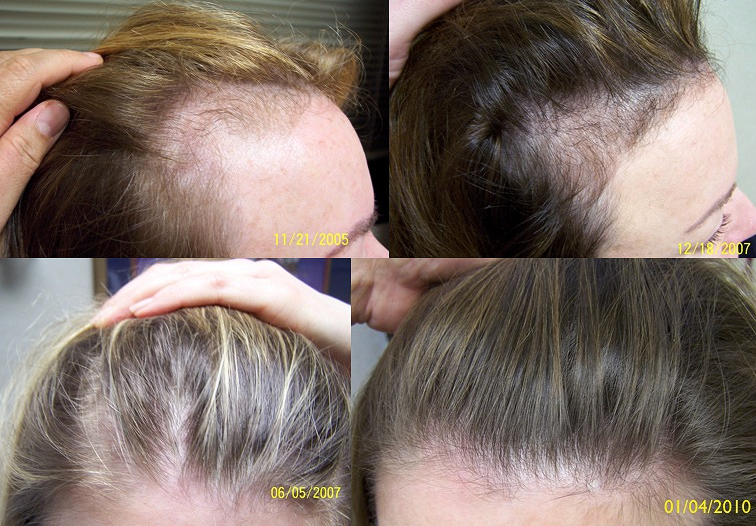 Выпадение волос после коронавируса, лечение волос после ковида
