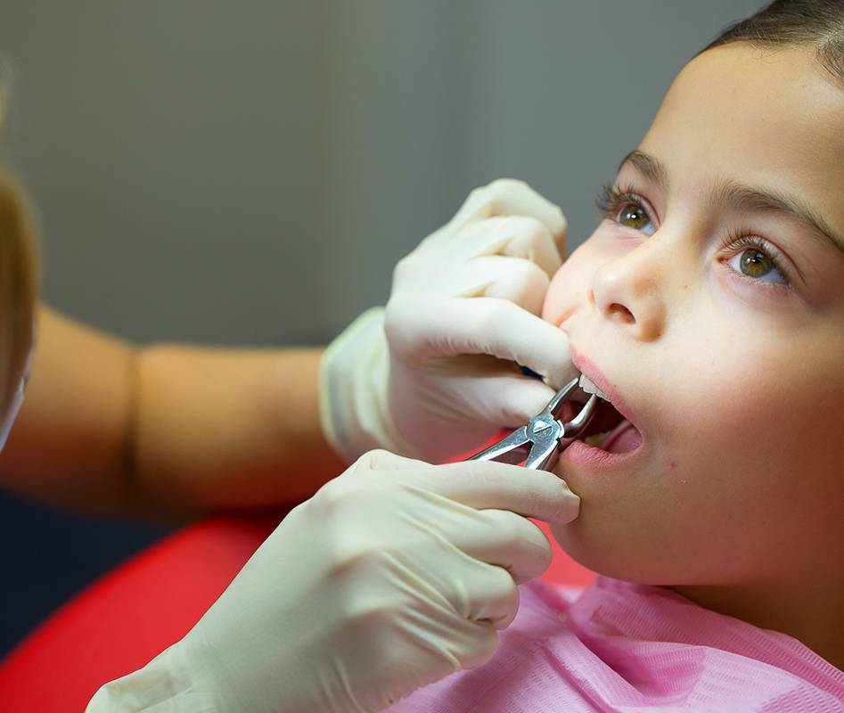 Как удаляют молочные зубы у детей: показания, последствия, рекомендации от silk