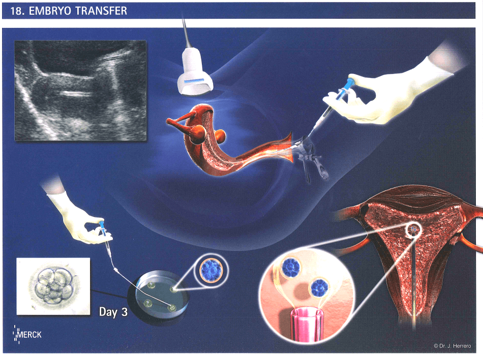 Что нужно знать перед эко  - статья репродуктивного центра «за рождение»