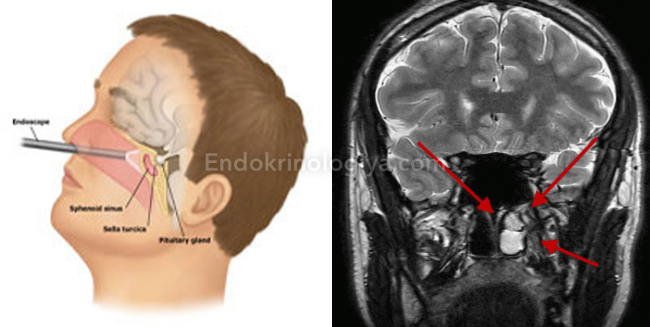 Киста в голове это. Микроаденома гипофиза головного мозга у женщин. Аденома гипофиза головного мозга симптомы. Опухоль гипофиза головного мозга.