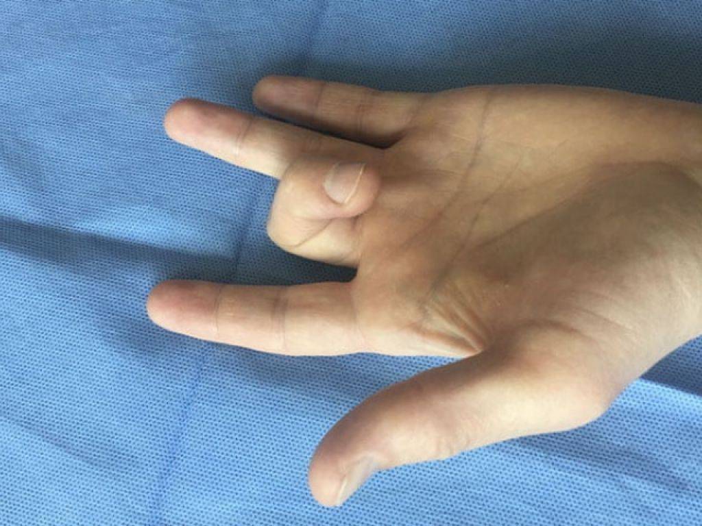 2 пальца на запястье. Стенозирующий лигаментит. Болезнь Нотта. Стенозирующий лигаментит пальца. Стенозирующий тендовагинит. Стенозирующий тендовагинит большого пальца.