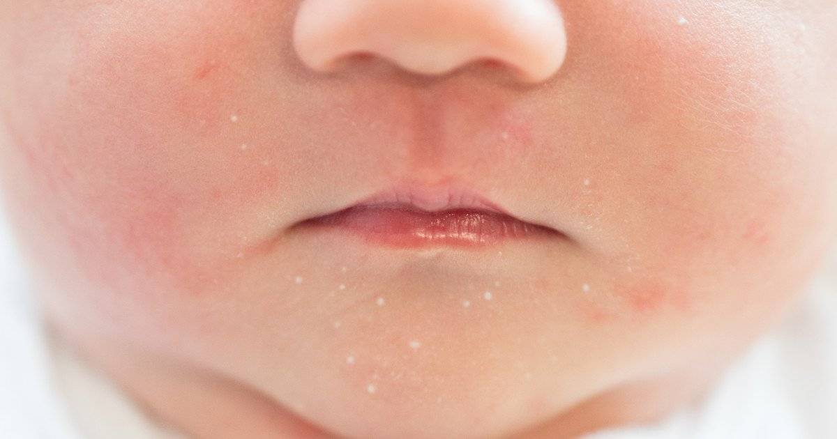 Акне на лице у новорожденных — причины появления, первые симптомы, профилактика