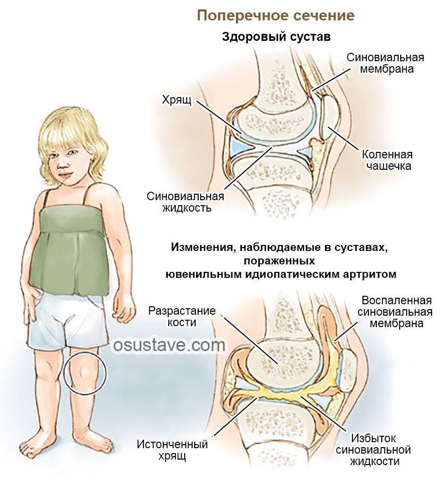 Воспаление тазобедренного сустава у ребенка - симптомы, причины и лечение артрита