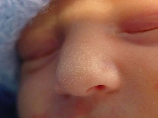 Белые точки на носу у новорожденного — что это такое