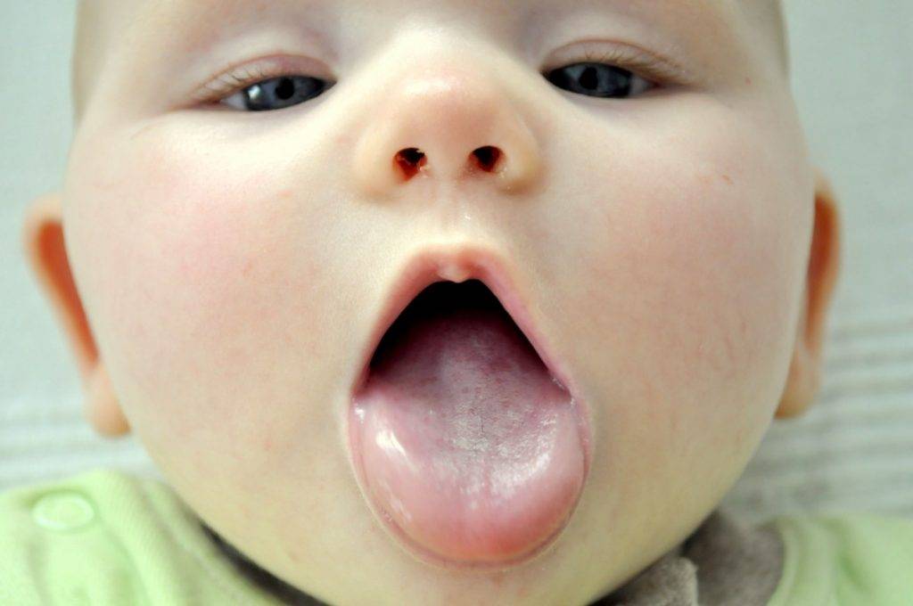 Кандидоз полости рта у детей: причины, симптомы, лечение и последствия