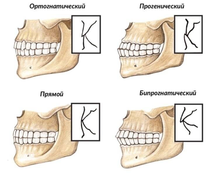 Как неправильный прикус может повлиять на здоровье ребенка