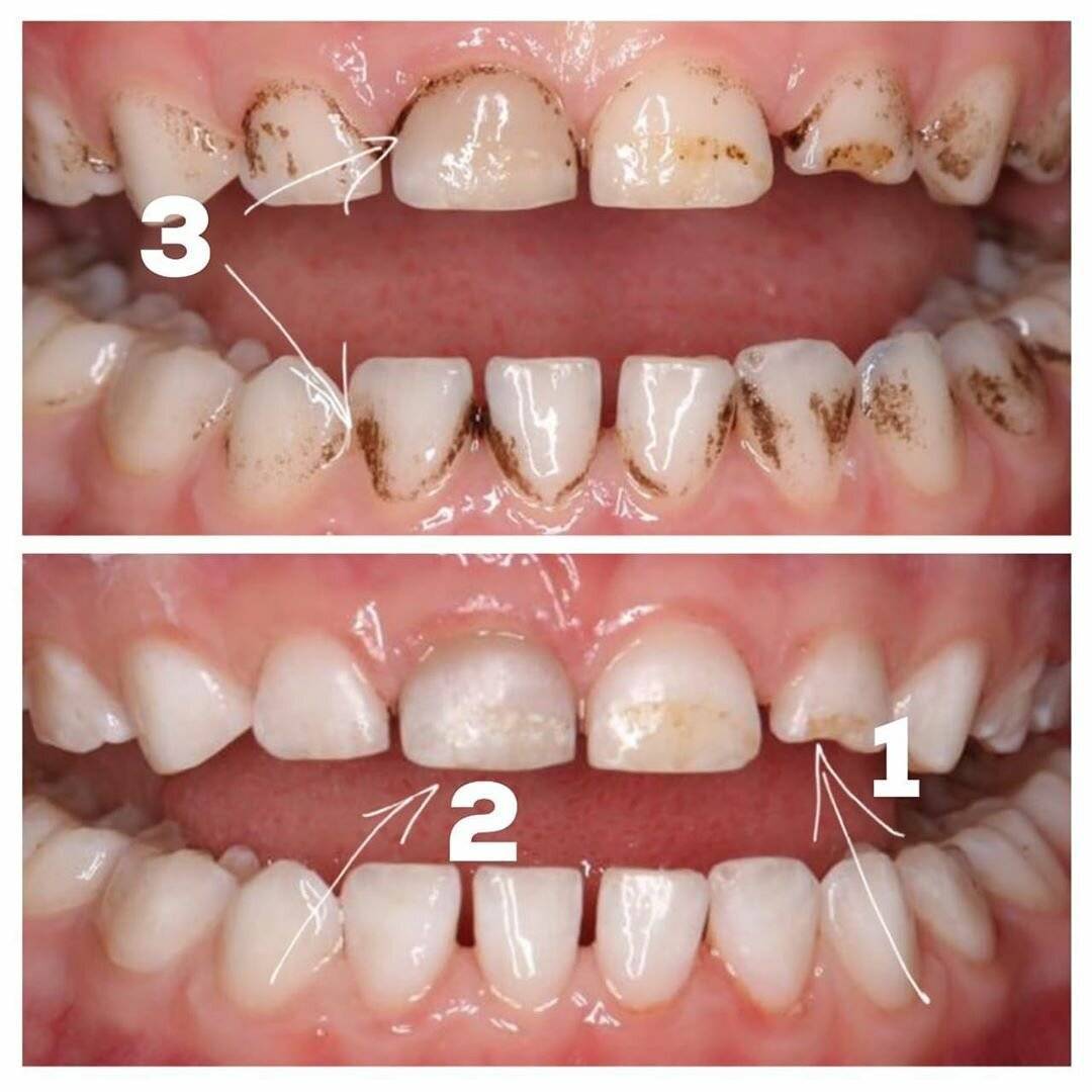 Чёрные зубы: почему они темнеют и как с этим бороться? — клиника доктора федорова